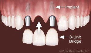 Dental Implants Replace Multiple Teeth
